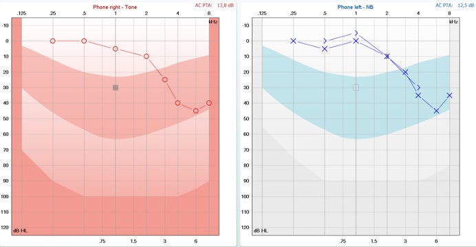 For both ears, the threshold increases as the frequency increases, reaching thresholds in the 20 to 45 dB range from 3 kHz and above.