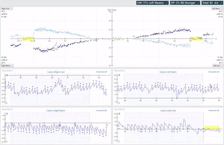 Results overview with pod and eye position views for right cool, right warm, left warm, and left cool irrigations. Unilateral weakness of 17%, left weaker. Directional preponderance of 2%, right-beating nystagmus stronger. For right cool, the average slow phase velocity is 21 and the fixation index is 13%. For right warm, the average slow phase velocity is 27 and the fixation index is 23%. For left warm, the average slow phase velocity is 19 and the fixation index is 7%. For left cool, the average slow phase velocity is 15 and the fixation index is 10%.