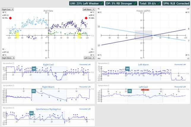 Results overview with pod and eye position views for right cool, right warm, left warm, and left cool irrigations. Unilateral weakness of 23%, left weaker. Directional preponderance of 3%, right-beating nystagmus stronger. For right cool, the average slow phase velocity is 11 and the fixation index is 75%. For right warm, the average slow phase velocity is 13 and the fixation index is not calculated. For left warm, the average slow phase velocity is 8 and the fixation index is 58%. For left cool, the average slow phase velocity is 7 and the fixation index is not calculated.