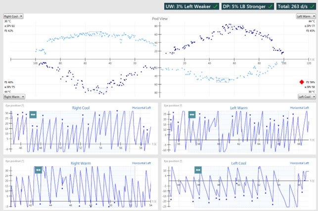 Results overview with pod and eye position views for right cool, right warm, left warm, and left cool irrigations. Unilateral weakness of 3%, left weaker. Directional preponderance of 5%, left-beating nystagmus stronger. For right cool, the average slow phase velocity is 61 and the fixation index is 42%. For right warm, the average slow phase velocity is 75 and the fixation index is 46%. For left warm, the average slow phase velocity is 77 and the fixation index is 45%. For left cool, the average slow phase velocity is 50 and the fixation index is 59%.