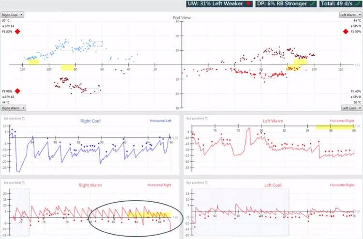 Results overview with pod and eye position views for right cool, right warm, left warm, and left cool irrigations. Unilateral weakness of 31%, left weaker. Directional preponderance of 6%, right-beating nystagmus stronger. For right cool, the average slow phase velocity is 14 and the fixation index is 83%. For right warm, the average slow phase velocity is 18 and the fixation index is 95%. For left warm, the average slow phase velocity is 9 and the fixation index is 59%. For left cool, the average slow phase velocity is 8 and the fixation index is 40%.