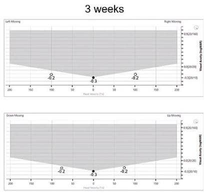 Horizontal static visual acuity of -0.3 LogMAR. Leftward DVA of -0.2 LogMAR. Rightward DVA of -0.2 LogMAR. Vertical static visual acuity of -0.3 LogMAR. Downward DVA of -0.2 LogMAR. Upward DVA of -0.2 LogMAR.