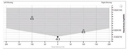 Horizontal static visual acuity of -0.3 LogMAR. Leftward DVA of 0.6 LogMAR. Rightward DVA of 0.0 LogMAR.