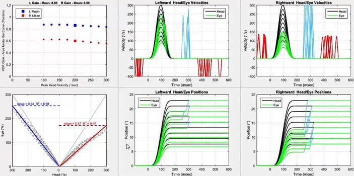 Six graphiques au total. Tout d'abord, un graphique avec le gain VOR en fonction de la vitesse maximale de la tête en degrés par seconde. Pour les impulsions gauches, le gain est inférieur à 1 mais supérieur au seuil de 0,8 pour toutes les vitesses de la tête. Pour les impulsions droites, le gain oscille autour de 0,6 pour toutes les vitesses de la tête. Deuxièmement, un graphique avec la vitesse oculaire en degrés par seconde en fonction de la vitesse de la tête en degrés par seconde. Pour afficher les données pour les impulsions gauches et droites, l'axe des x est divisé en deux parties identiques, avec une vitesse de la tête de zéro degré par seconde au milieu, allant jusqu'à 300 degrés par seconde de chaque côté pour chaque direction d'impulsion de la tête. Ainsi, un gain VOR de 1 donnerait une ligne où la vitesse de la tête et de l'œil étaient toujours égales. Pour les impulsions gauches, le nuage de points se situe légèrement en dessous de cette ligne, ce qui donne une pente de 0,84. Pour les impulsions droites, le nuage de points est bien en dessous de cette ligne, ce qui donne une pente de 0,57. Troisièmement et quatrièmement, nous avons les graphiques de vitesse et de position pour les impulsions gauches. Dans le graphique de vitesse, les mouvements de la tête et des yeux sont tracés avec la vitesse, en degrés par seconde, en fonction du temps, en millisecondes. Pour la vitesse, les vitesses oculaires maximales correspondent bien aux vitesses oculaires maximales jusqu'à 250 degrés par seconde. Des saccades manifestes assez importantes se produisent entre 250 et 300 millisecondes. Des phases rapides de nystagmus spontané dans la direction opposée sont visibles avant et après l'impulsion de la tête. Dans le graphique de position, les mouvements de la tête et des yeux sont tracés avec la position, en degrés, en fonction du temps, en millisecondes. Pour la position, les positions des yeux sont immédiatement en retard par rapport aux positions de la tête, les saccades manifestes devant correspondre aux positions de la tête à 15 degrés et plus. Cinquièmement et sixièmement, nous avons les graphiques de vitesse et de position pour les impulsions vers la droite. Pour la vitesse, les vitesses maximales des yeux ne correspondent bien aux vitesses maximales de la tête que jusqu'à 150 degrés par seconde. Les saccades manifestes à grande vitesse se produisent à 300 millisecondes. Des phases rapides de nystagmus spontané dans la même direction sont visibles avant et après l'impulsion de la tête. Pour la position, les saccades manifestes sont nécessaires pour correspondre à toutes les positions de la tête.