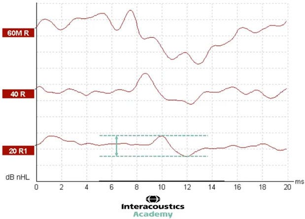 Graph with dB nHL as a function of milliseconds. Two horizontal, dotted lines show the peak of wave V and the following trough. An arrow between these two dotted lines shows the distance, which is the amplitude. The amplitude is roughly 8 dB nHL.