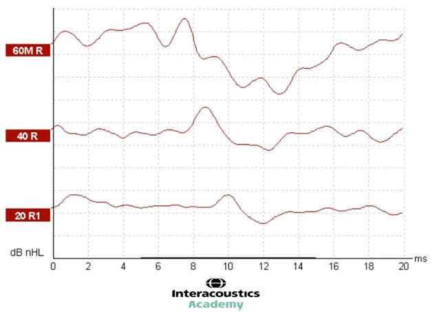 Graph with dB nHL as a function of milliseconds. All three waveforms have clearly identifiable wave Vs.