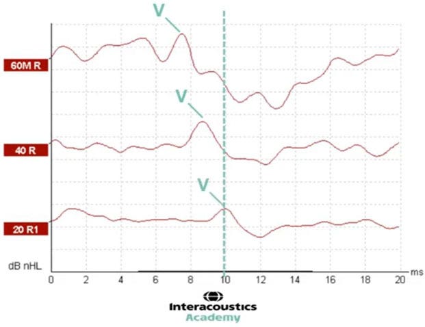 Graph with dB nHL as a function of milliseconds. A vertical, dotted line at 10 milliseconds shows the latency of wave V for the 20 dB nHL intensity level.