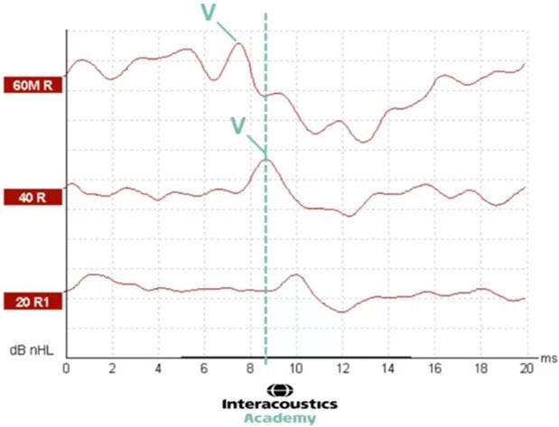 Graph with dB nHL as a function of milliseconds. A vertical, dotted line at 8.5 milliseconds shows the latency of wave V for the 40 dB nHL intensity level.