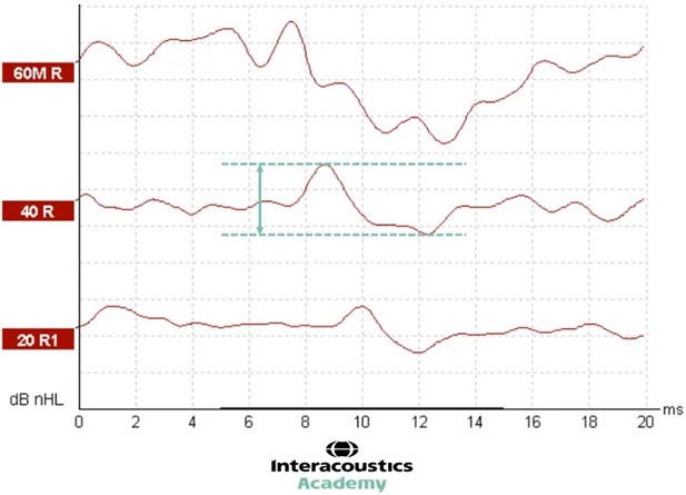 Graph with dB nHL as a function of milliseconds. Two horizontal, dotted lines show the peak of wave V and the following trough. An arrow between these two dotted lines shows the distance, which is the amplitude. The amplitude is roughly 10 dB nHL.