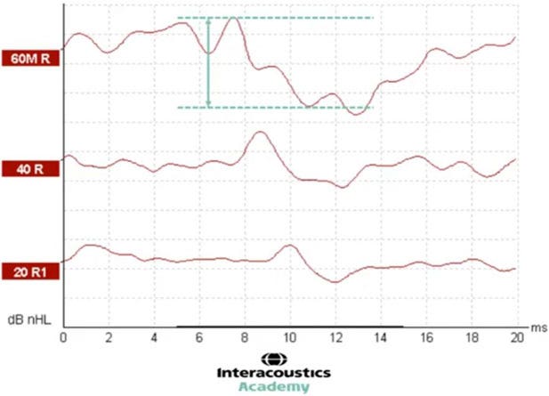 Graph with dB nHL as a function of milliseconds. Two horizontal, dotted lines show the peak of wave V and the following trough. An arrow between these two dotted lines shows the distance, which is the amplitude. The amplitude is roughly 15 dB nHL.