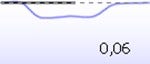 A downward-oriented acoustic reflex with a deflection value of 0,06.