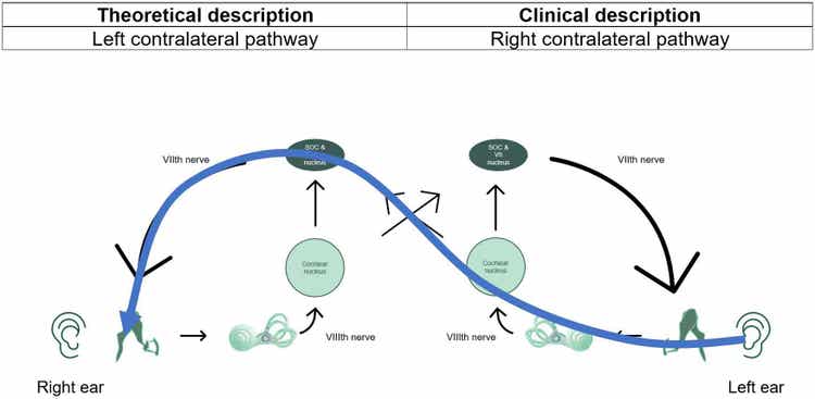 Contralateral pathway showed with blue line for stimulus in left ear and probe in right ear. The theoretical description is the left contralateral pathway, whereas the clinical description is the right contralateral pathway.