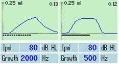 Reflex morphology for acoustic reflexes elicited with pulsed and continuous stimuli. With the pulsed stimulus, the deflection value has a sharp peak. With the continuous stimulus, the deflection value has a flat peak.