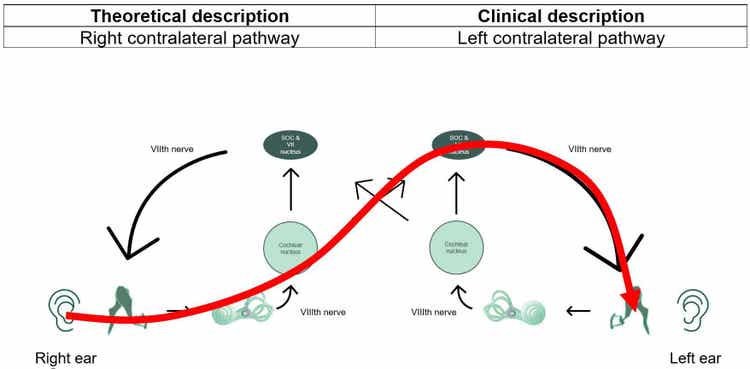 Contralateral pathway showed with red line for stimulus in right ear and probe in left ear. The theoretical description is the right contralateral pathway, whereas the clinical description is the left contralateral pathway.