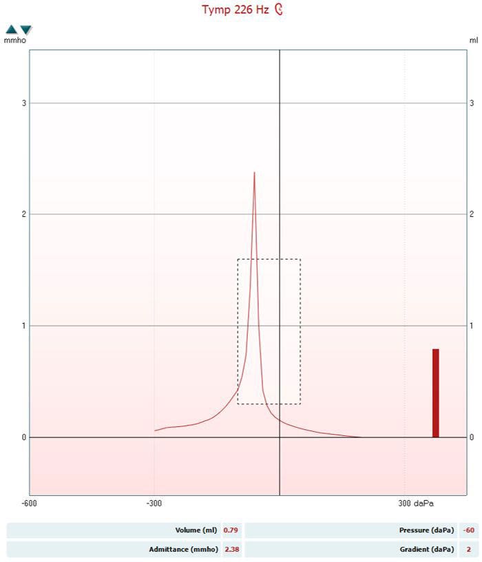 The tympanogram has the following values. Volume, measured in ml, is 0.79. Pressure, measured in daPa, is minus 60. Admittance, measured in mmho, is 2.38. Gradient, measured in daPa, is 2. These values produce a curve with a very sharp and tall peak at minus 60 daPa.