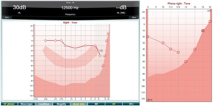 High-frequency audiogram for the right ear, with dB as a function of kHz and hearing thresholds recorded from 0.25 to 12.5 kHz. Between 0.25 to 8 kHz, the hearing threshold ranges between 10 to 25 dB. At 10 kHz, the hearing threshold is 30 dB. At 12.5 kHz, the hearing threshold is 40 dB.