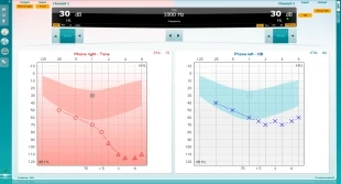 Audiograms displaying hearing loss in both ears