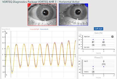 Horizontal active subtest screen for VORTEQ active head rotation. 81% gain at 1 and 2 hz. 1 degree phase lag at 1 hz. 0 degree phase at 2 hz. Smooth sinusoids for eye position that follow the target position nicely.