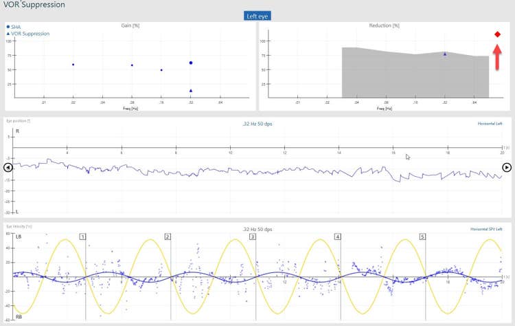 VOR suppression results screen, showing abnormal reduction value, visible with result located in grey shaded area.