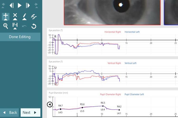 The Pupil Diameter graph is below the horizontal and vertical eye tracing graphs. It has mm as a function of time for the right and left eyes. In this example, the user has added four measurements in the 0 to 15 second range.
