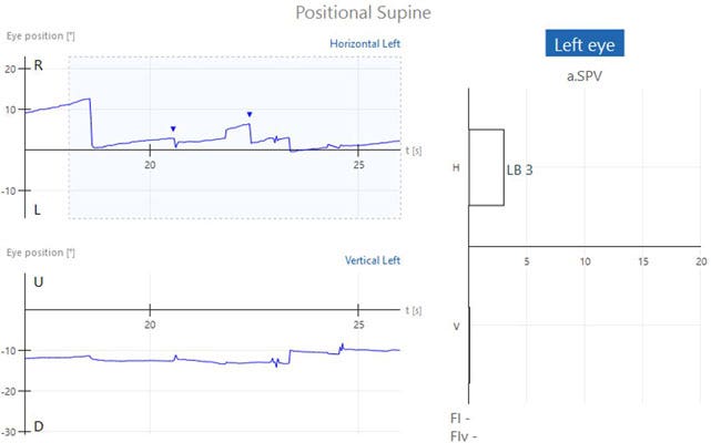 Graphs with eye position in degrees as a function of time in seconds. Two recorded beats of horizontal, left-beating nystagmus, yielding a left-beating nystagmus with an average slow phase velocity of 3. This is within the normal range of 0 to 6.