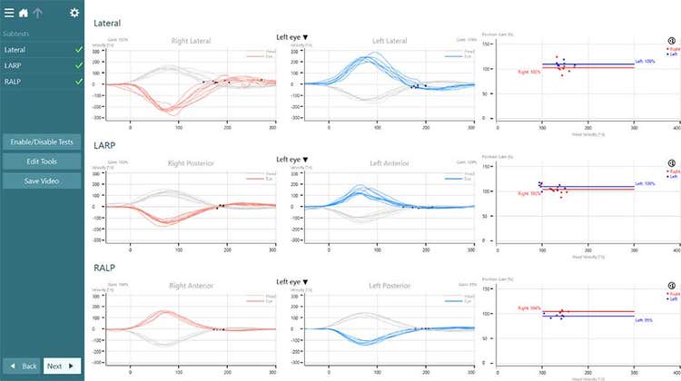 vHIT for VORTEQ results overview, including the subtests lateral, LARP, and RALP. Each of the three subtests display results for eye velocity and position gain.