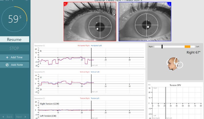 Lateral Head Roll test screen. To the left the user has the options to Resume, STOP, Add Time, or Add Note. In the middle there is a live video feed of the right and left eyes and horizontal, vertical, and torsional eye position data. The 3D head model is to the right, displaying the current head position visually and in the amount of degrees.