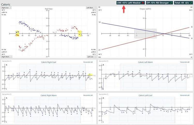 Abnormal caloric results, showing a unilateral weakness of 43%.