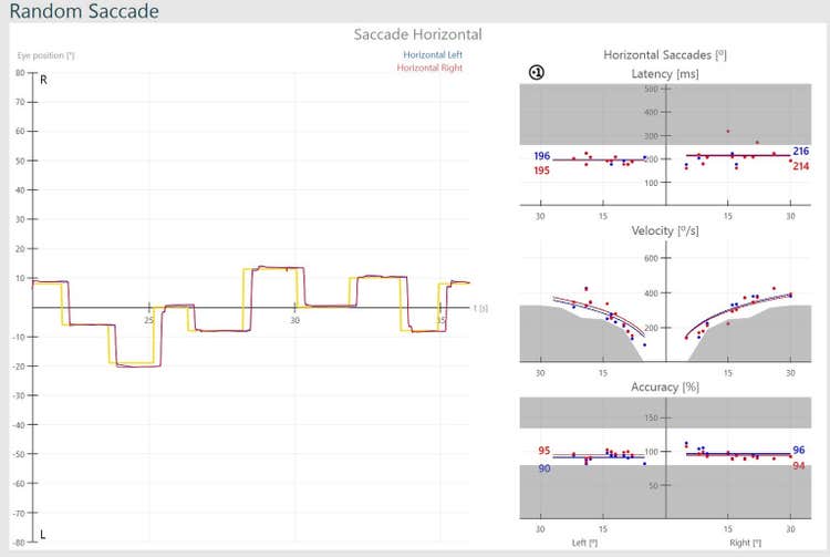 Results overview for horizontal saccade test. Red and blue curves for right and left eye movements follow the yellow curve for target position smoothly and quickly. Graphs for latency, velocity, and accuracy indicate normal results, with results located in the white, normal regions, and not in the grey, abnormal regions.