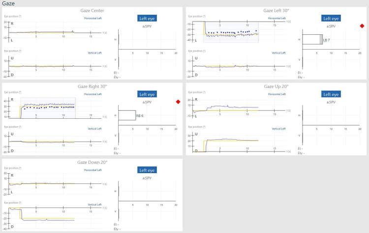 Gaze results overview, including gaze center, gaze right 30 degrees, gaze down 20 degrees, gaze left 30 degrees, and gaze up 20 degrees. For gaze right and left 30 degrees, horizontal left, the blue curve for eye position is jagged, indicating nystagmus. For right 30 degrees, the average slow phase velocity of the nystagmus is 6. For left 30 degrees, the average slow phase velocity of the nystagmus is 7. The nystagmus peaks are marked with a blue triangle, and the failed subtests are flagged with a red diamond.