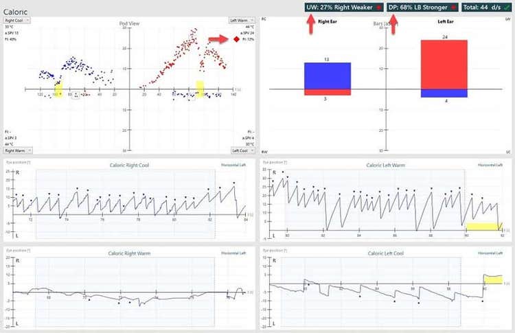 Abnormal caloric results, showing a unilateral weakness of 27% and directional preponderance of 68%.