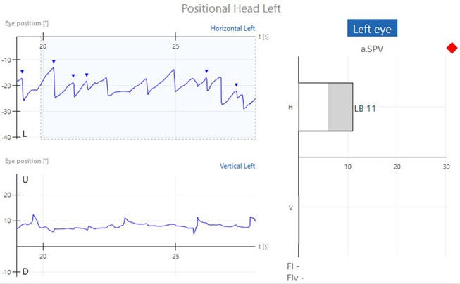 Graphs with eye position in degrees as a function of time in seconds. Six recorded beats of horizontal, left-beating nystagmus, yielding a left-beating nystagmus with an average slow phase velocity of 11. This is above the normal range of 0 to 6.
