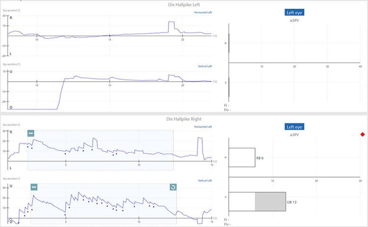 Dix-Hallpike right results showing a right-beating nystagmus with an average slow-phase velocity of 6 and an up-beating nystagmus with an average slow-phase velocity of 13.