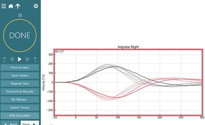 Normal right head impulse displayed in majority of the screen. A list of options are available to the left, including the following: print screen, save video, repeat test, numerical results, 3d waves, select traces, and edit saccades.