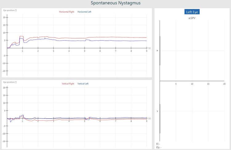 Graphs for eye position in the horizontal and vertical directions. The eye tracings are more or less flat in both directions. Thus, no nystagmus detected.