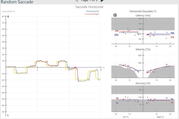 Results overview for horizontal saccade test. Red and blue curves for right and left eye movements are jagged. Graphs for velocity and accuracy indicate abnormal results, with results located in the grey, abnormal regions.