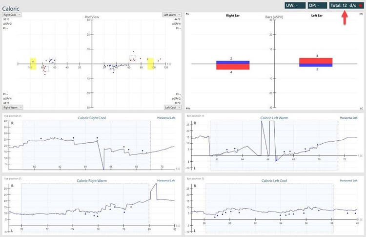 Abnormal caloric results, showing a bilateral weakness.