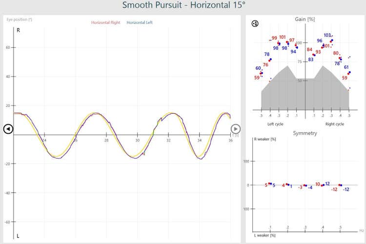 Normal smooth pursuit results, including a smooth sinusoid for eye position, gain results in the white, normal region, and normal symmetry.