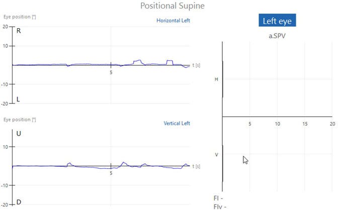 Graphs with eye position in degrees as a function of time in seconds. No horizontal or vertical nystagmus, visible by almost flat traces close to zero degrees. Another graph showing the average slow phase velocity also shows no horizontal or vertical nystagmus.