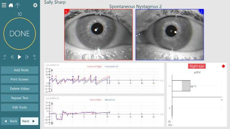 Results overview for spontaneous nystagmus. Left-beating nystagmus with an average slow phase velocity of 11.