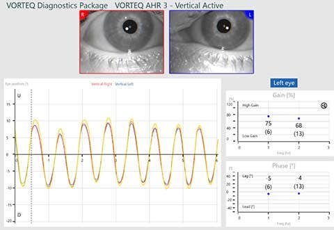 Vertical active subtest screen for VORTEQ active head rotation. 75% gain at 1 hz and 68% gain at 2 hz. 5 degree phase lead at 1 hz. 4 degree phase lead at 2 hz. Smooth sinusoids for eye position that fall a bit short of the target position.