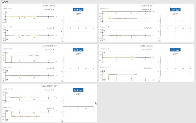 Gaze results overview, including gaze center, gaze right 30 degrees, gaze down 20 degrees, gaze left 30 degrees, and gaze up 20 degrees. For all subtests, the blue curve for eye position follows the yellow curve for target position almost perfectly.