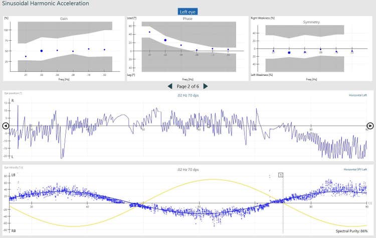 Normal SHA test results, displaying gain, phase, symmetry, eye position and eye velocity.