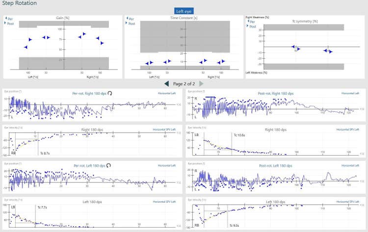 Velocity step test results screen, showing normal results for gain, time constant, symmetry, eye position and eye velocity.