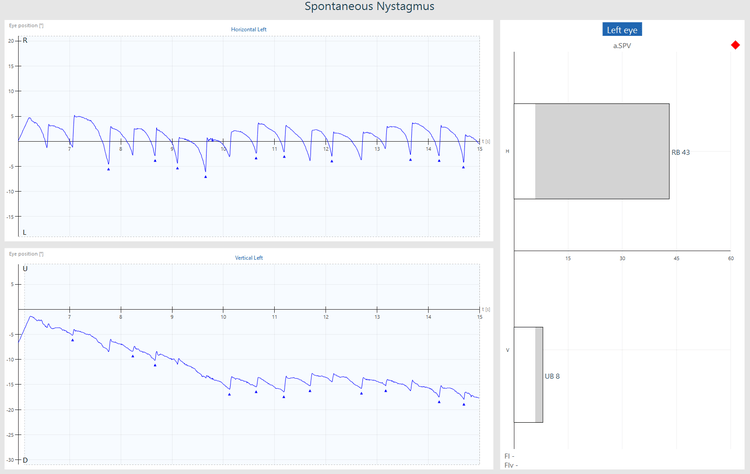 Graphs for eye position in the horizontal and vertical directions. Both the horizontal and vertical eye tracings are jagged. The presence of nystagmus is flagged by a red diamond, and with a grey shaded region of the a.SPV bar graph from 6-43 for horizontal and 6-8 for vertical.