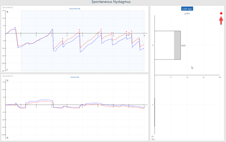Graphs for eye position in the horizontal and vertical directions. The horizontal eye tracings in particular are jagged. The presence of nystagmus is flagged by a red diamond, and with a grey shaded region of the a.SPV bar graph from 6-8.