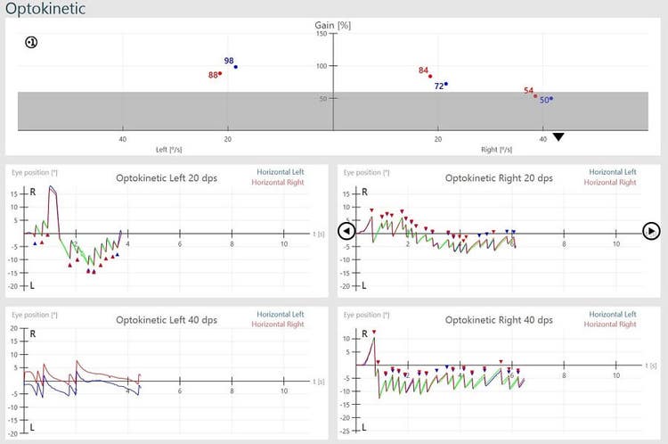 Results overview for right and left optokinetic nystagmus results, for 20 dps and 40 dps. For optokinetic left 20 dps, left horizontal gain is 98%, right horizontal gain is 88%, and eye position hovers between -15 to 20 degrees. For optokinetic left 40 dps, no gains are calculated. For optokinetic right 20 dps, left horizontal gain is 72%, right horizontal gain is 84%, and eye position hovers between -10 to 10 degrees. For optokinetic right 40 dps, left horizontal gain is 50%, right horizontal gain is 54%, and eye position hovers between -15 to 10 degrees.