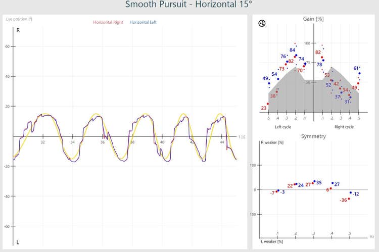 Abnormal smooth pursuit results, including a jagged sinusoid for eye position, gain results in the grey, abnormal region, and abnormal symmetry.