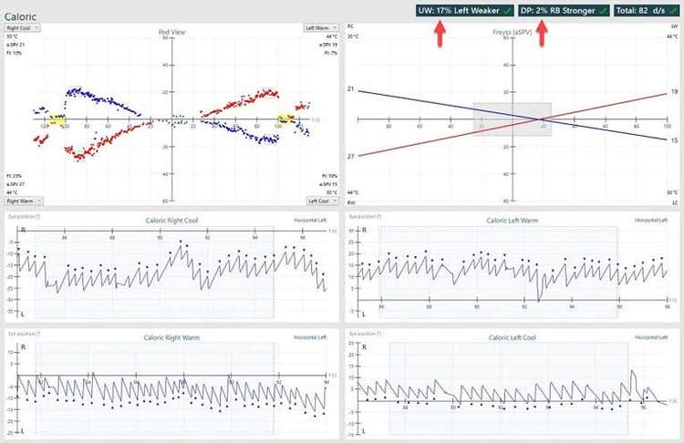 Normal caloric results, showing a unilateral weakness of 17% and directional preponderance of 2%.