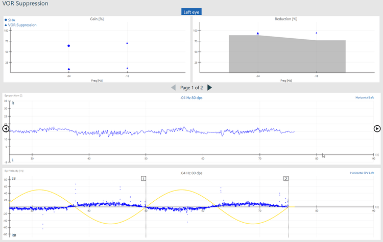 VOR suppression results screen, showing normal results for gain, reduction, eye position and eye velocity.